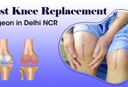 Best Knee Replacement Surgeon In Delhi NCR