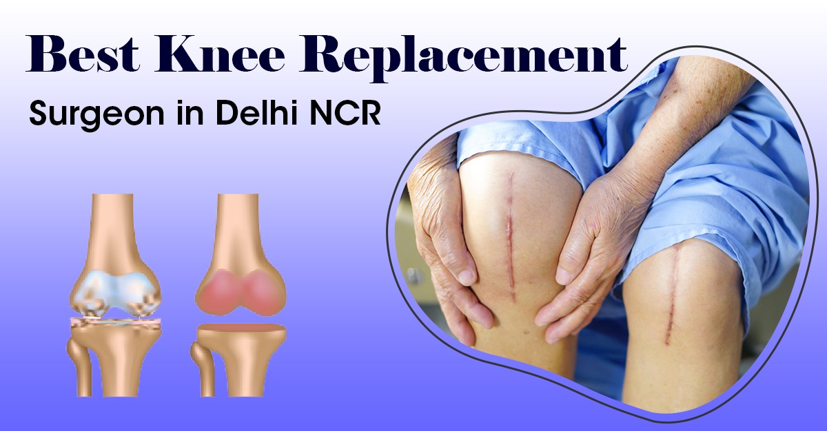 Best Knee Replacement Surgeon In Delhi NCR