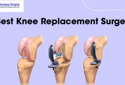Best Knee Replacement Surgery