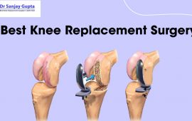 Best Knee Replacement Surgery