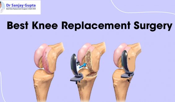 Best Knee Replacement Surgery