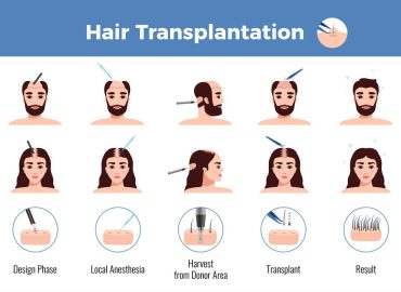 Best hair doctor in Indirapuram