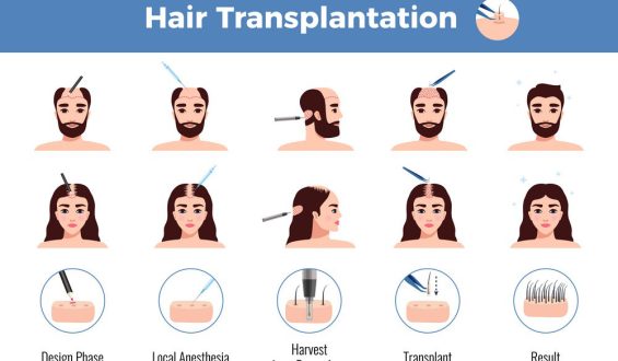 Best hair doctor in Indirapuram